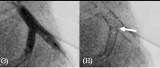 ΠΑΡΟΥΣΙΑΣΗ ΤΗΣ ΤΕΧΝΙΚΗΣ ΤΑP-STENTING (T-STENTING AND SMALL-PROTRUSION) Α. Τοποθέτηση stent στο κύριο αγγείο και οδηγού σύρματος στον πλάγιο κλάδο Β.