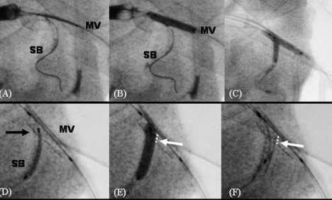 Τοποθέτηση stent στον πλάγιο κλάδο ώστε να καλύπτει το κεντρικό (ή πάνω) άκρο του στομίου του και ένα μπαλόνι στον κύριο αγγείο Ε. Έκπτυξη του stent στον πλάγιο κλάδο F.