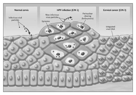 HPV τύποι 6,11,16,18 Οι τύποι 6,11 προκαλούν το 90% των κονδυλωμάτων Τύπος 6 Τύπος 11