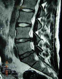 al. Disc degeneration and associated abnormalities of the spine in elite gymnasts.