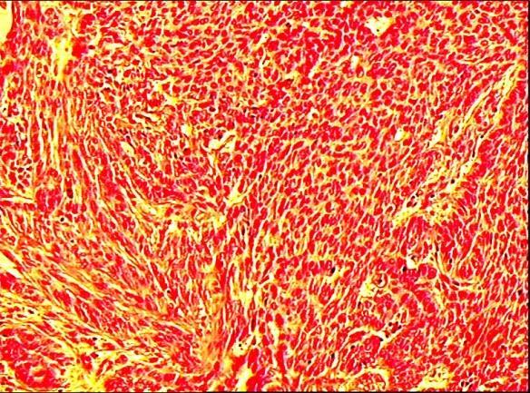 Δείγμα 5865 180 160 Dermis 140 120 100 80 Epidermis-BCC 60 40