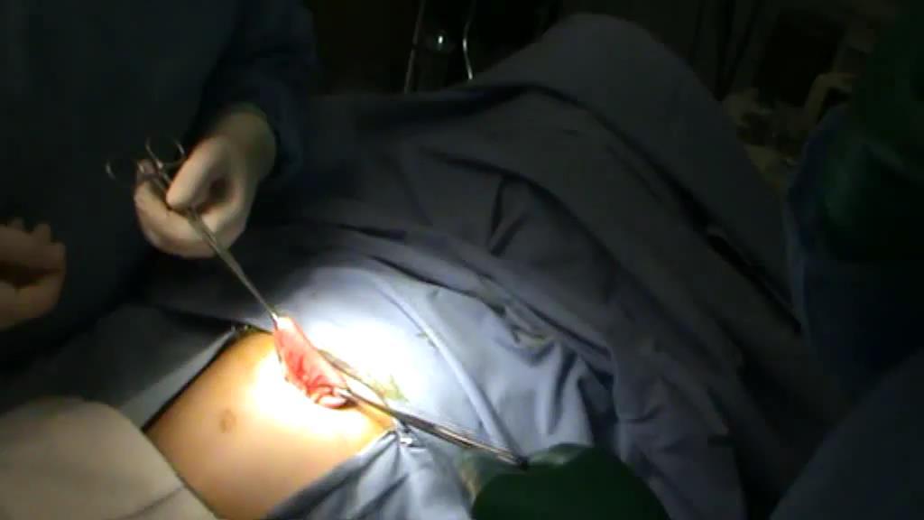 ΑΝΤΙΜΕΤΩΠΙΣΗ Η ασθενής υπεβλήθη σε λαπαροτομία και γαστροτομή, όπου αφαιρέθηκε τριχοπίλημα με μορφή εκμαγείου του στομάχου