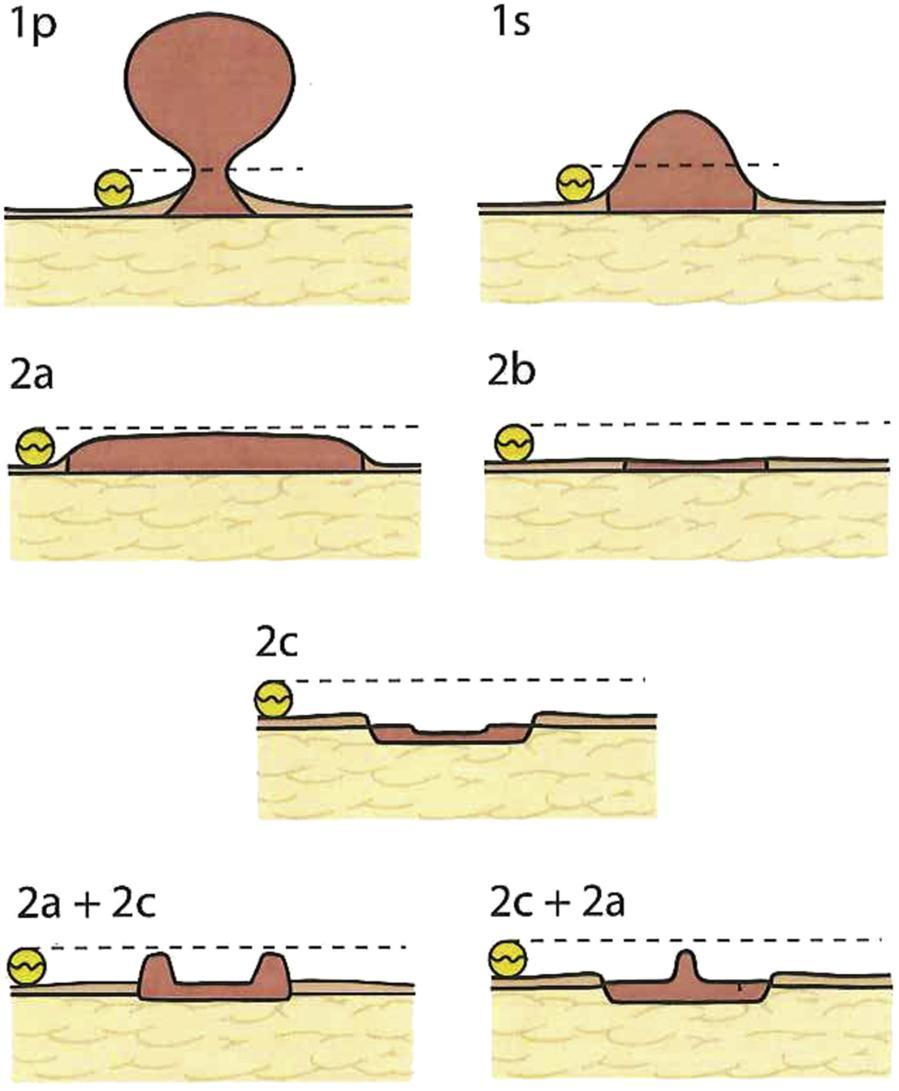 Ταξινόμηση Παρισίων ESGE recommends that gross morphology of polyps should be described using the Paris classification system and sized in millimeters.