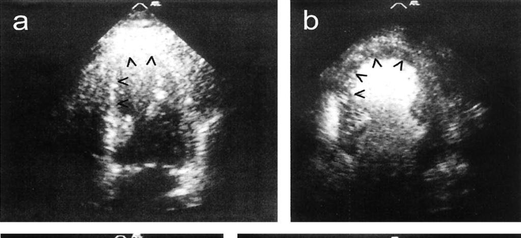 J Am Coll Cardiol, 2001; 38:19-25
