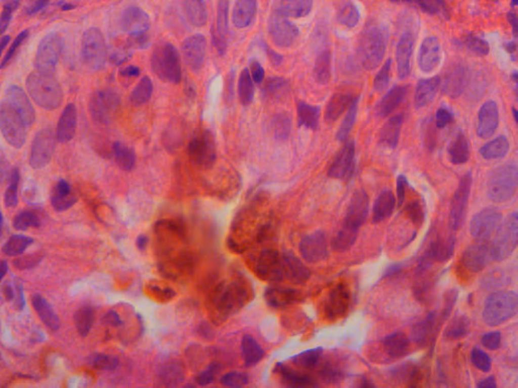 ινοβλάστες. Τα πλακώδη κύτταρα και οι ινοβλάστες είναι αρνητικοί. Μεγέθυνση: x400. Εικόνα 24.