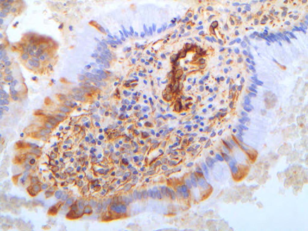 Εικόνα 28. Ανοσοχρώση επιτόπου Η. Εγκάρσια τομή ενδοτραχηλικού πολύποδα που παρουσιάζει στρωματικά και ενδοθηλιακά κύτταρα με έντονη κυτταροπλασματική χρώση.