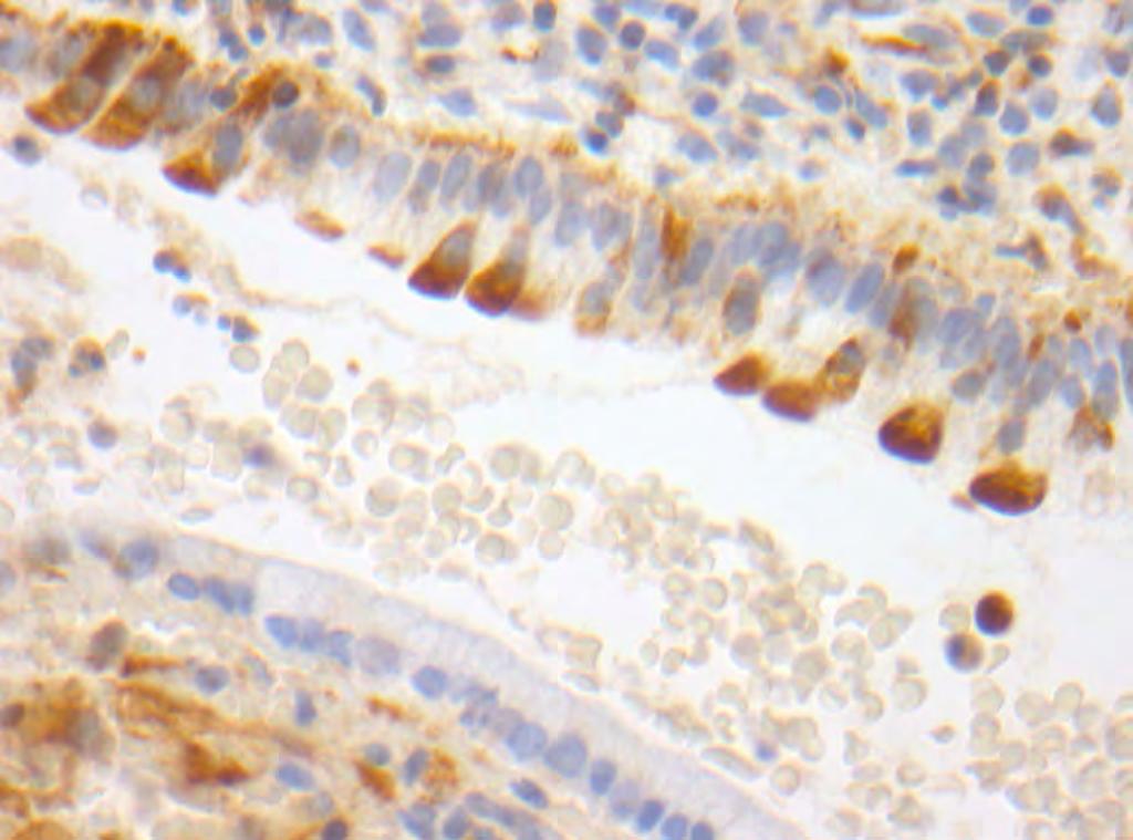 Εγκάρσια τομή δύο μικρών ενδοτραχηλικών πολυπόδων που παρουσιάζουν στρωματικά κύτταρα με κυτταροπλασματική χρώση. Τα λεμφοκύτταρα του στρώματος είναι αρνητικά.
