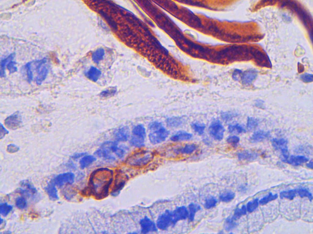 κυτταροπλασματική χρώση (κεφαλή βέλους), αποφολιδωμένα επιφανειακά πλακώδη κύτταρα με