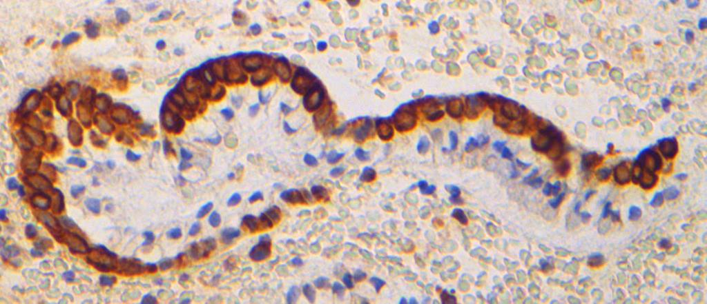 Εικόνα 3. Ανοσοχρώση επιτόπου Η. Βλεννοπαραγωγά κύτταρα αρνητικά (βέλος).