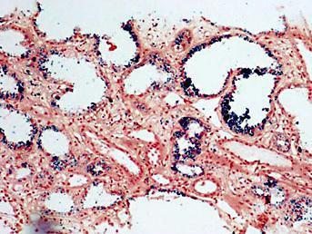 σωληναριακών κυττάρων, σε ιστολογικές τομές νεφρού ΠΝΑ ασθενών (Russell P. Rother et al, 2005, Hussain S et al, 2013). Εικόνα 3.
