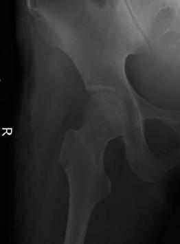 with early idiopathic avascular necrosis of