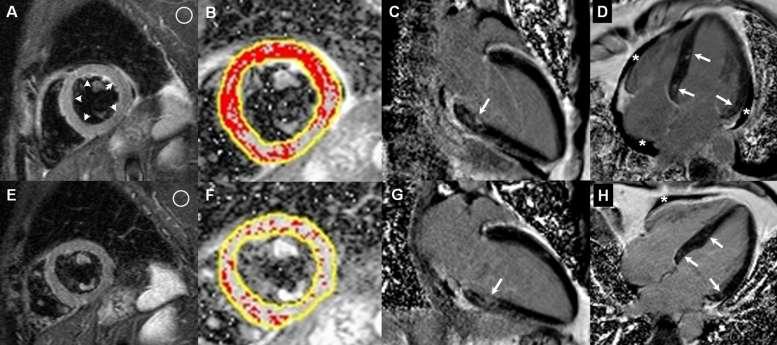 Myocarditis mimicking reverse Tako-tsubo Cardiomyopathy