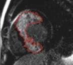 Prognostic Significance of LGE-CMR in HCM 220 HCM patients 20 patients died (9%)