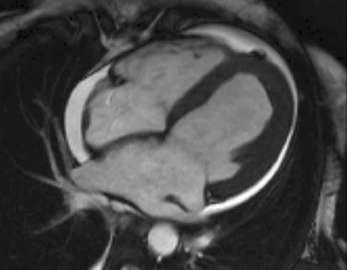Endomyocardial Fibrosis Severe