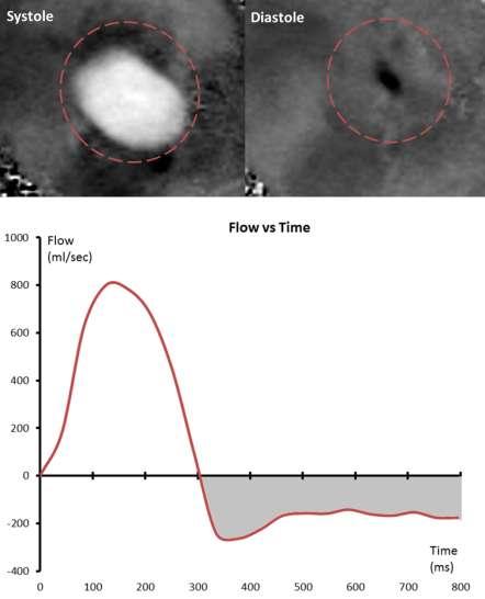 Aortic Regurgitation Forward flow: 125ml Regurgitant volume: 47ml