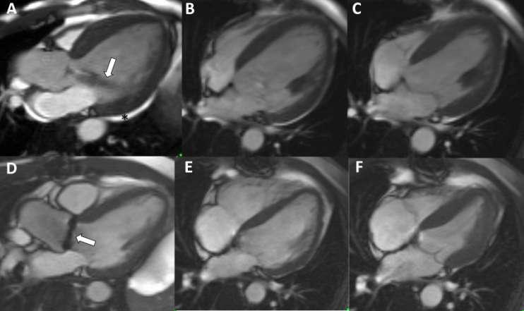 AORTIC REGURGITATION LV remodelling 2009 2010