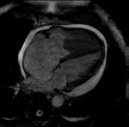 Myxoma 