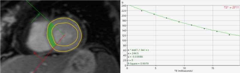 T2* imaging:
