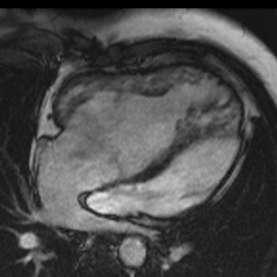 Congenital Heart Disease 26 yrs old man with TGA Senning
