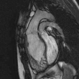 with moderate dysfunction Baffle functioning well; Systemic and