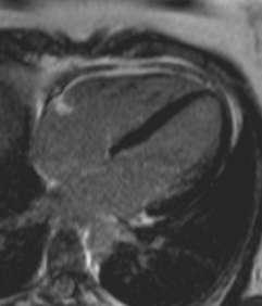 Late Gadolinium Enhancement Patterns Amyloidosis NORMAL Myocarditis