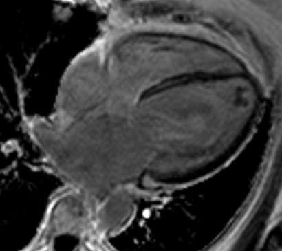non-ischaemic