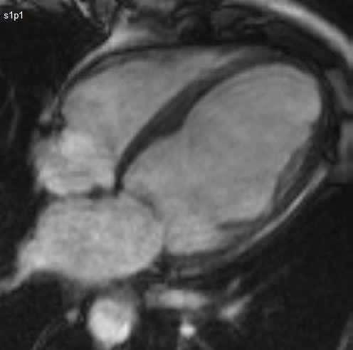 Ischaemic