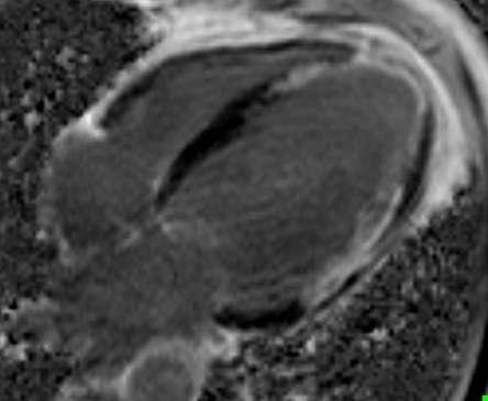 Non-ischaemic