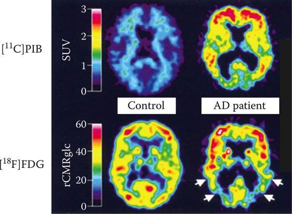 Απεικόνιση της νόσου Alzheimer Το β-αμυλοειδές είναι ένα κολλώδες πεπτίδιο, που συσσωρεύεται σε πλάκες και φαίνεται να καταστρέφει τα εγκεφαλικά κύτταρα των ασθενών Το ραδιοισότοπο PIB συνδέεται με