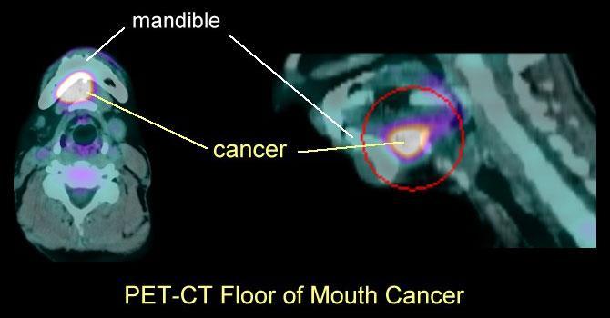 Συνδυασμένη απεικόνιση PET/CT στην