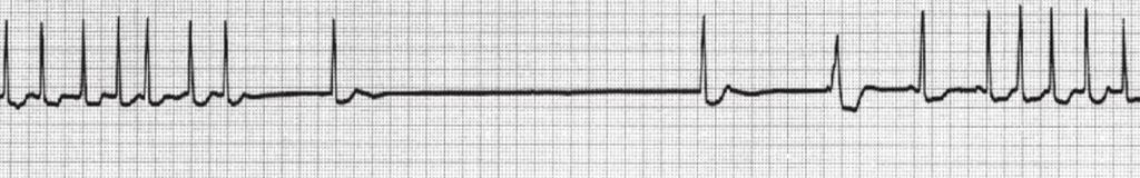 a variant of sick sinus syndrome the arrhythmia alternates between slow and fast heart rates