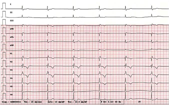 Absence of electrical and mechanical activity of the atria.