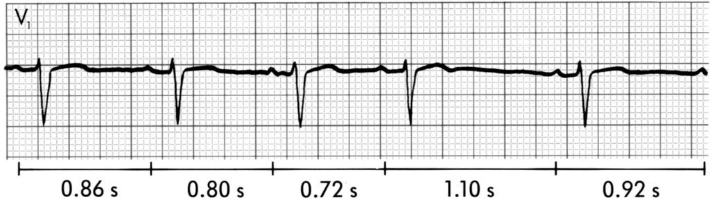 2 nd degree type I