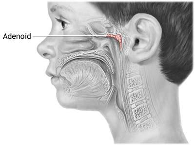 Αδενοειδείς εκβλαστήσεις και χρόνια ρινοκολπίτιδα