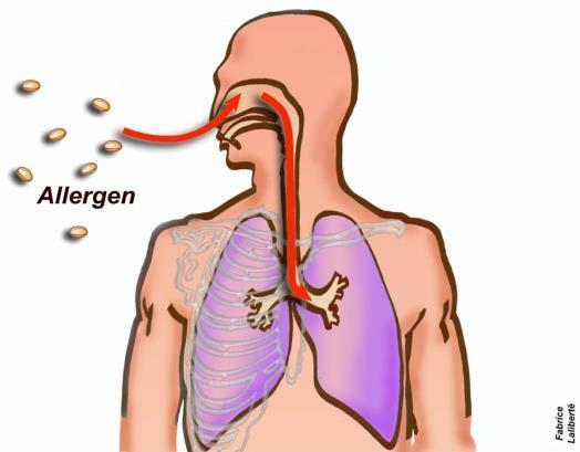 Προδιαθεσικοί παράγοντες Βρογχικό άσθμα