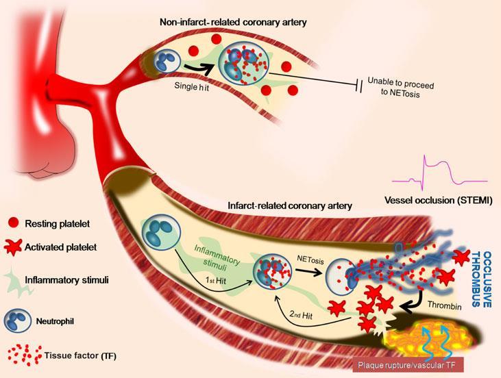A schematic representation of the two hit TF/NET model in STEMI (Stakos et al, European Heart Journal, 2015). Recently, the implication of NETs in fibrosis has also been demonstrated.