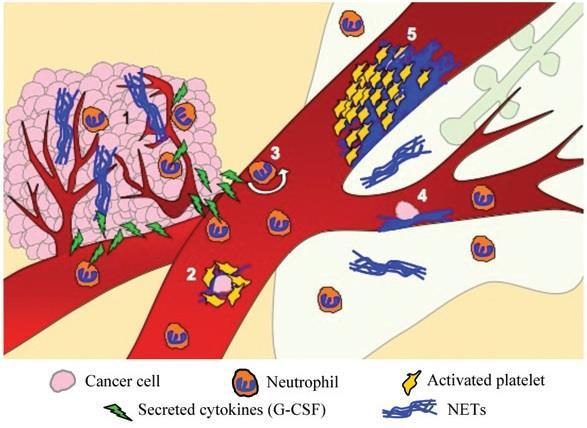 NETs could be implicated in many steps of tumor progression (Demers et al, OncoImmunology, 2013).