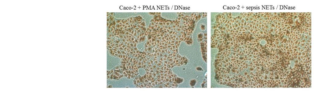 Both PMA and sepsis serum-induced NETs inhibited in vitro Caco-2 growth compared to controls (Figure 2), which also demonstrated apoptotic-like morphology.