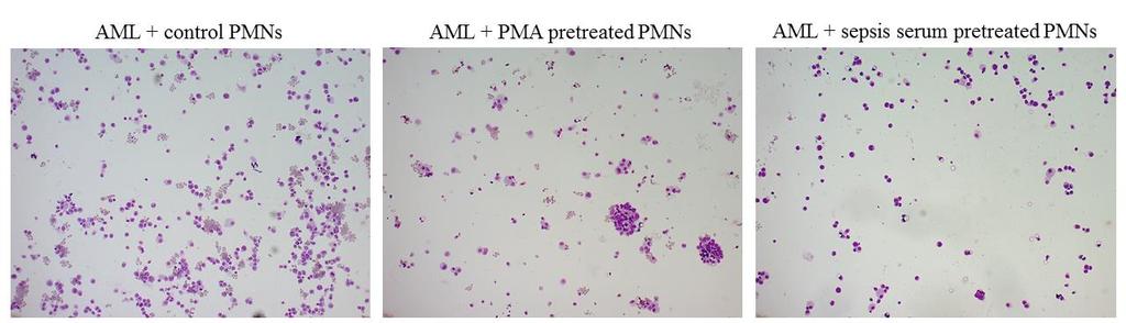 Figure 7. PMA or sepsis serum-pretreated neutrophils inhibit growth of AML cells in vitro. May-Grünwald-Giemsa staining of AML cells co-cultured with PMNs pretreated with PMA or sepsis serum.