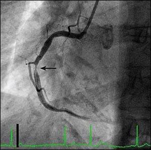In most cases mechanical revascularization with angioplasty is mandatory to resolve symptoms of angina and/or
