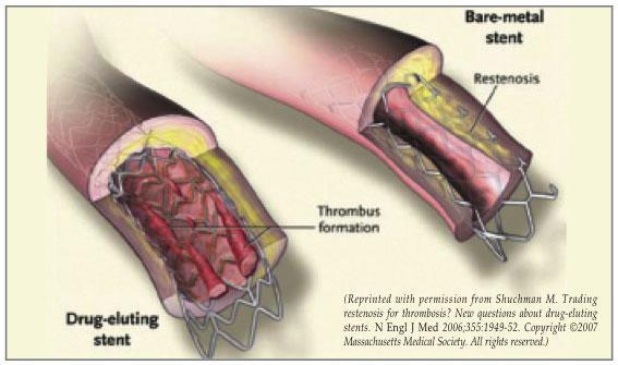 Percutaneous revascularization is performed by inserting a special catheter in the coronary arteries from the groin of the arm.