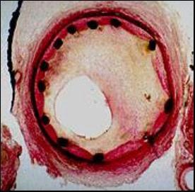 [11] Restenosis is a >50% reduction in lumen diameter after percutaneous coronary intervention, and is the result of arterial damage with subsequent neointimal tissue proliferation (figure 7).