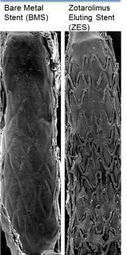Figure 10. Re-endothelization after 30 days with BMS or DES stents.