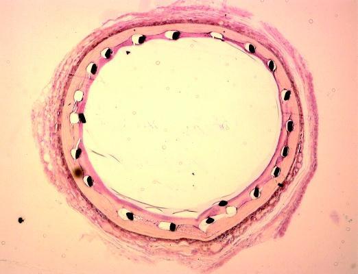 Restenosis pathophysiology When a stent is placed in a blood vessel produces a vessel wall injury and a healing response initiates.