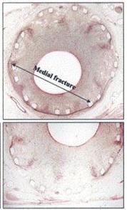 This is a favorable effect because development of normal lining over the stent allows blood to flow smoothly over the stented area without clotting since it is known that metallic struts activate