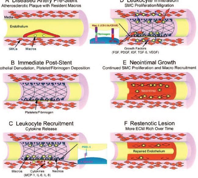 Figure 17. Schematic of an integrated cascade of restenosis. A, Atherosclerotic vessel before intervention.