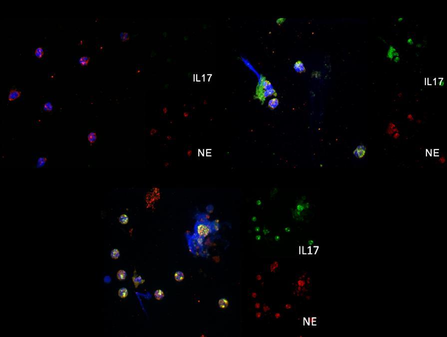 Figure 33. Both stent types induce NET generation from control neutrophils. Upper panel: Untreated control neutrophils stained for IL-17 and neutrophil elastase (NE).