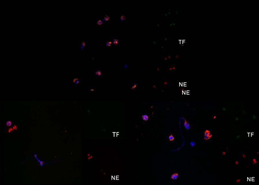 Figure 34. Stent-induced NETs did not express tissue factor (TF) Upper panel: Untreated control neutrophils stained for TF and neutrophil elastase (NE).