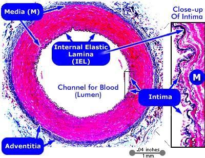 worldwide.[1-5] It affects the coronary arteries by producing narrowing of the vessels that supply the heart (figure 1). Figure 1. Atheroeclerotic plaque producing vessel norowing.