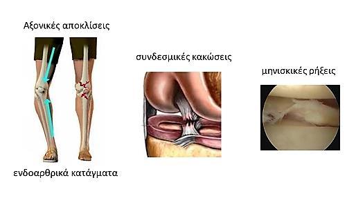 Οι βλάβεσ του αρκρικοφ χόνδρου ςυχνά ςυςχετίηονται με οξείσ τραυματιςμοφσ ςυνδζςμων ι μθνίςκων, τραυματικά